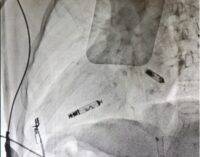 VOGHERA 19/12/2024: Pacemaker bicamerale senza fili in un paziente. Intervento record all’ospedale cittadino